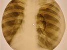 USSR X-RAY ROENTGEN BONES RECORD ORIGINAL OLD RIBS 517