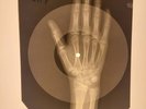 X-RAY USSR  HAND ROENTGEN BONES RECORD ORIGINAL OLD RIBS 508