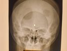 USSR X-RAY SKULL ROENTGEN BONES RECORD ORIGINAL OLD RIBS 511