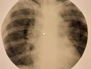 USSR X-RAY  ROENTGEN BONES RECORD ORIGINAL OLD RIBS 527
