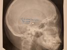 USSR X-RAY SKULL ROENTGEN BONES RECORD ORIGINAL OLD RIBS 519