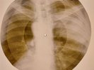 USSR X-RAY  ROENTGEN BONES RECORD ORIGINAL OLD RIBS 521