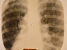 X-RAY USSR  ROENTGEN BONES RECORD ORIGINAL OLD RIBS 529