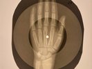 X-RAY USSR  ROENTGEN BONES RECORD ORIGINAL OLD RIBS 528