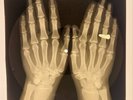 RING  X-RAY USSR  ROENTGEN BONES RECORD ORIGINAL OLD RIBS 546