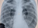 USSR X-RAY  ROENTGEN BONES RECORD ORIGINAL OLD RIBS 562