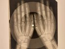 X-RAY HANDS USSR  ROENTGEN BONES RECORD ORIGINAL OLD RIBS 525