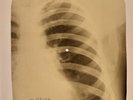 X-RAY USSR  ROENTGEN BONES RECORD ORIGINAL OLD RIBS 541