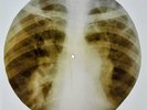 X-RAY USSR  ROENTGEN BONES RECORD ORIGINAL OLD RIBS 570