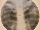 X-RAY USSR  ROENTGEN BONES RECORD ORIGINAL OLD RIBS 547