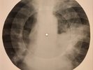 USSR X-RAY ROENTGEN BONES RECORD ORIGINAL OLD RIBS 534