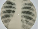 USSR X-RAY  ROENTGEN BONES RECORD ORIGINAL OLD RIBS 578