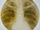 X-RAY USSR  ROENTGEN BONES RECORD ORIGINAL OLD RIBS 574