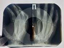 X-RAY USSR  ROENTGEN BONES RECORD ORIGINAL OLD RIBS 559