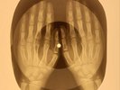 X-RAY USSR  ROENTGEN BONES RECORD ORIGINAL OLD RIBS 594