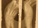 78 rpm X-RAY HANDS USSR ROENTGEN BONES RECORD ORIGINAL OLD RIBS 604