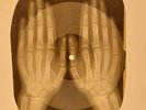 78 rpm X-RAY HANDS USSR ROENTGEN BONES RECORD ORIGINAL OLD RIBS 613
