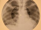 X-RAY USSR ROENTGEN BONES RECORD ORIGINAL OLD RIBS 622