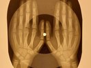 X-RAY USSR  ROENTGEN BONES RECORD ORIGINAL OLD RIBS 633
