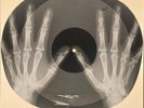 X-RAY HANDS USSR  ROENTGEN BONES RECORD ORIGINAL OLD RIBS 637