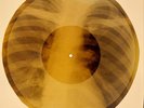 X-RAY USSR ROENTGEN BONES RECORD 78 rpm ORIGINAL OLD RIBS 651