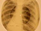 X-RAY USSR ROENTGEN BONES RECORD 78 rpm ORIGINAL OLD RIBS 665