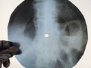 DAVID BOWIE BEWLEY BROTHERS X-Ray USSR Record Roentgen Bone Ribs Music Vinyl