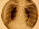 78 rpm X-RAY USSR ROENTGEN BONES RECORD ORIGINAL OLD RIBS 614