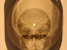 USSR X-RAY SKULL ROENTGEN BONES RECORD ORIGINAL OLD RIBS 624