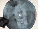 DAVID BOWIE LIFE ON MARS X-Ray USSR Record Roentgen Bone Ribs Music Vinyl