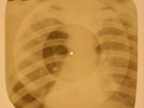 78 rpm X-RAY USSR ROENTGEN BONES RECORD ORIGINAL OLD RIBS 611