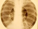 X-RAY USSR ROENTGEN BONES RECORD ORIGINAL OLD RIBS 695