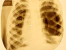 X-RAY USSR ROENTGEN BONES RECORD ORIGINAL OLD RIBS 699