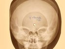 USSR X-RAY SKULL ROENTGEN BONES RECORD ORIGINAL OLD RIBS 686