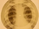 X-RAY USSR ROENTGEN BONES RECORD 78 rpm ORIGINAL OLD RIBS 725