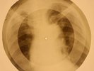 X-RAY USSR ROENTGEN BONES RECORD 78 rpm ORIGINAL OLD RIBS 737