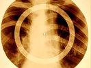 X-RAY USSR ROENTGEN BONES RECORD ORIGINAL OLD RIBS 792
