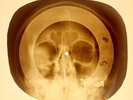 USSR X-RAY SKULL ROENTGEN BONES RECORD ORIGINAL OLD RIBS 801