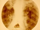X-RAY USSR ROENTGEN BONES RECORD 78 rpm ORIGINAL OLD RIBS 852