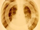 X-RAY USSR ROENTGEN BONES RECORD ORIGINAL OLD RIBS 795