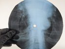 DAVID BOWIE LIVE ON MARS X-Ray USSR Record Roentgen Bone Ribs Music Vinyl