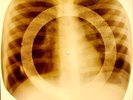 X-RAY USSR ROENTGEN CHILD BONES RECORD ORIGINAL OLD RIBS 863