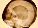 USSR X-RAY SKULL ROENTGEN BONES RECORD ORIGINAL OLD RIBS 865