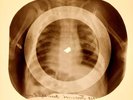 X-RAY USSR ROENTGEN CHILD BONES RECORD ORIGINAL OLD RIBS 873