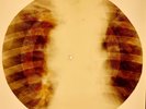 X-RAY USSR ROENTGEN BONES RECORD ORIGINAL OLD RIBS 858