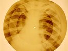 X-RAY USSR ROENTGEN BONES RECORD ORIGINAL OLD RIBS 881