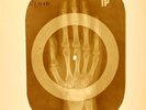 USSR X-RAY HAND ROENTGEN BONES RECORD ORIGINAL OLD RIBS 880