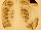 X-RAY USSR ROENTGEN BONES RECORD ORIGINAL OLD RIBS 872