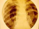 X-RAY USSR ROENTGEN BONES RECORD ORIGINAL OLD RIBS 860