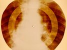 X-RAY USSR ROENTGEN BONES RECORD ORIGINAL OLD RIBS 893